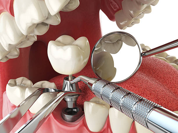 Best Emergency Root Canal Treatment in USA